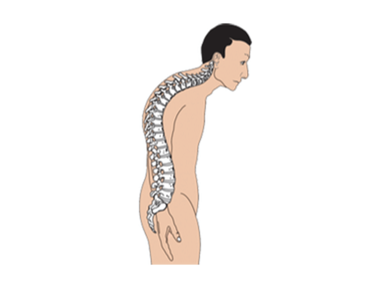 Illustration of a man standing with a curved spine