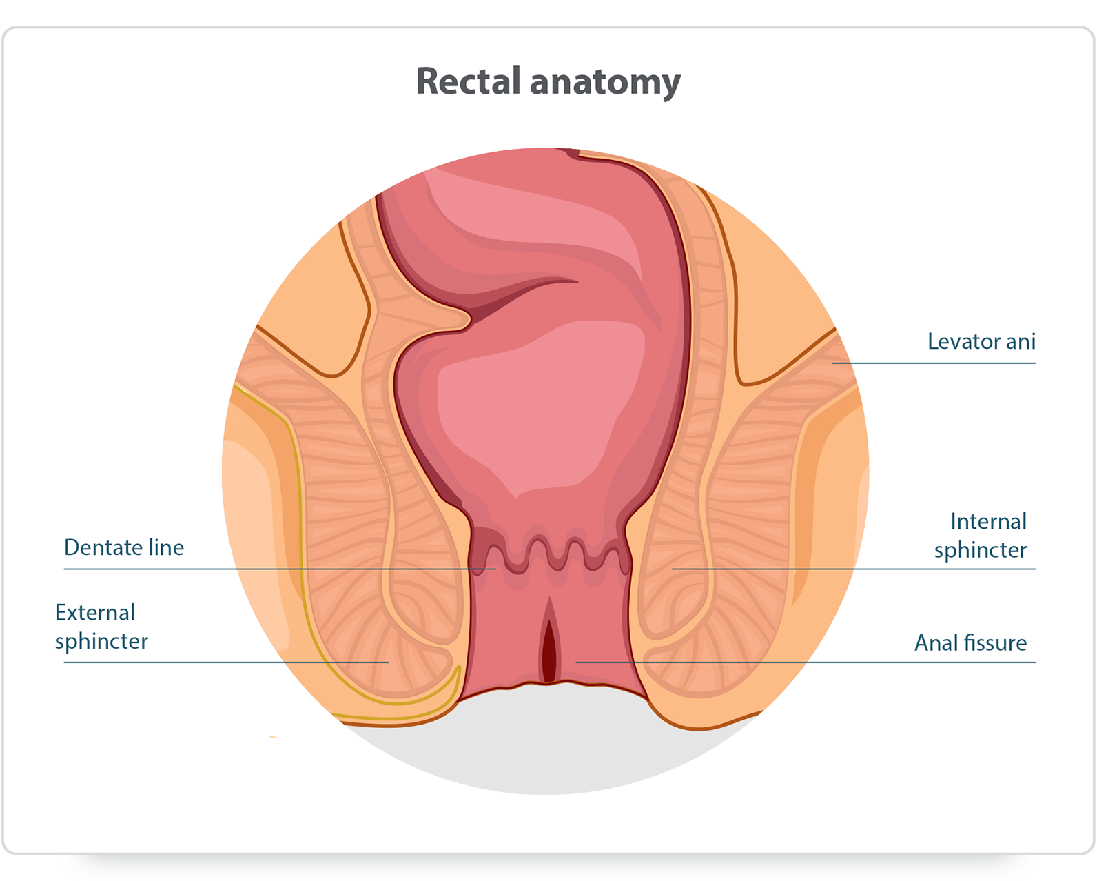 Rectal anatomy showing levator ani, dentate line, internal and external sphincters and an anal fissure